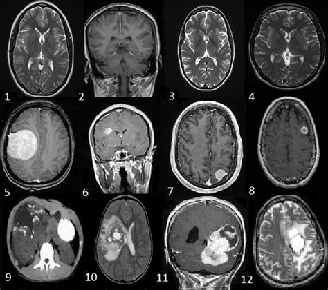 Brain Mri Scan Tumor