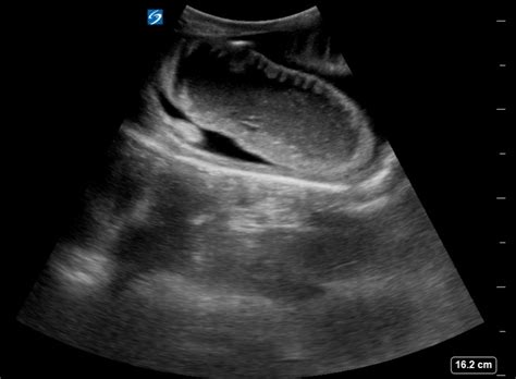 Incarcerated Inguinal Hernia