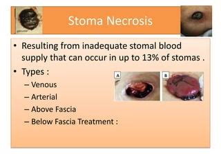 Stoma complications by Prof. Ajay Khanna, IMS, BHU, Varanasi India