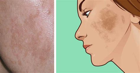 Suffer from melasma? Here are 6 natural ways to treat the skin ...