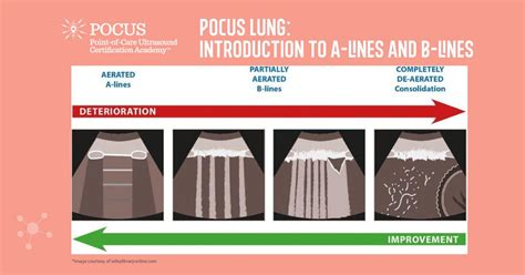 POCUS Lung – Introduction to A-lines and B-lines | Point-of-Care ...