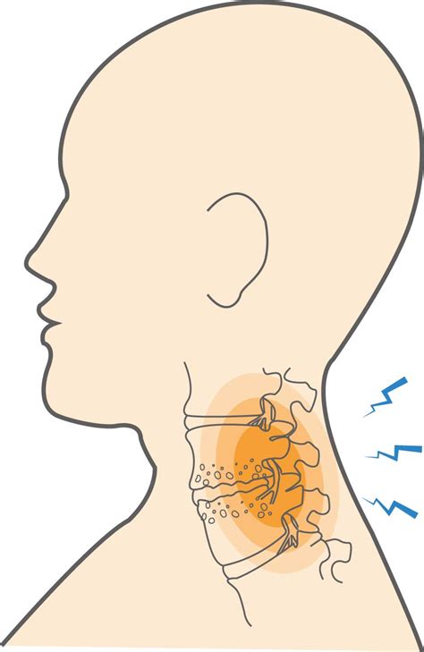 What is Cervical Spinal Stenosis & How Does It Affect You? - Upswing Health