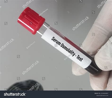 Blood Sample Serum Osmolality Test Helps Stock Photo 2224600807 ...