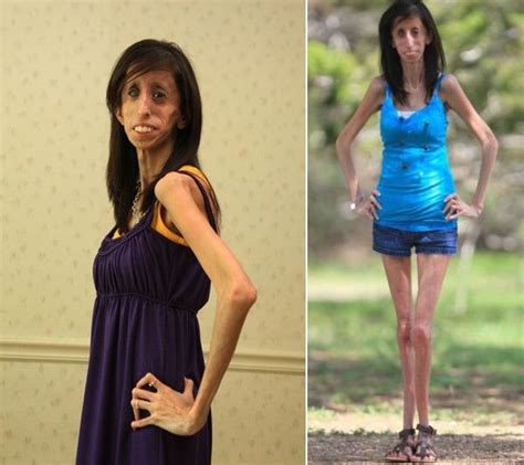 Skinniest Person in the World - Lizzie Velasquez | Skinny people ...