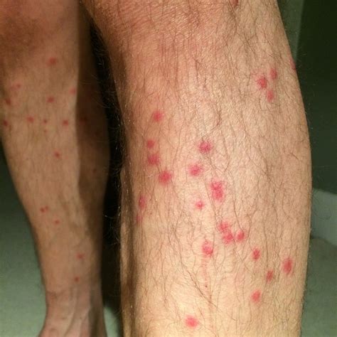 Midge bites — how to recognise midges, treat bites and avoid both ...