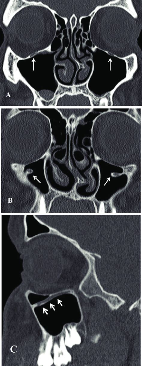 Coronal and sagittal CT scan. (A) Normal infraorbital bony canal ...