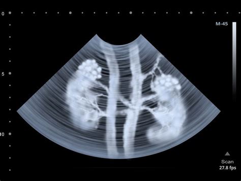 Clear Insights: Understanding Kidney Health through Ultrasound Scans ...