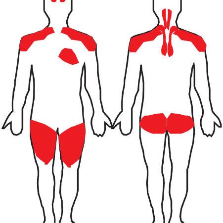 Representative image of periostitis in a patient developing ...