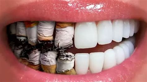 How Smoking Causes Gum Disease | The Effects of Smoking on Teeth