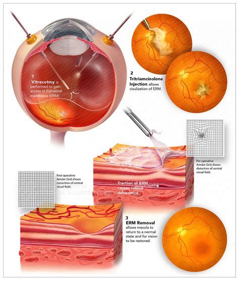 Vitrectomy Membrane Peeling