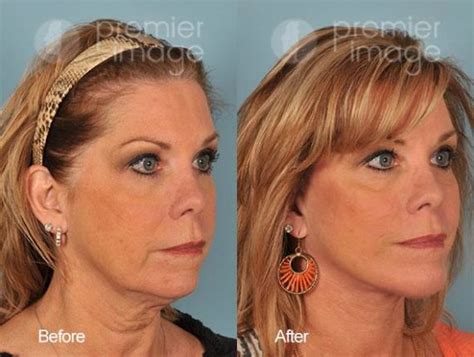 QT Mini-Facelift Before and after photos | Sandy Springs, GA | Patient ...