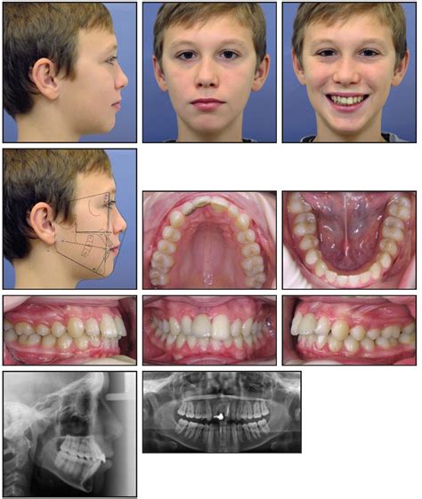 Mini-Implants for Space Closure of Missing Incisors