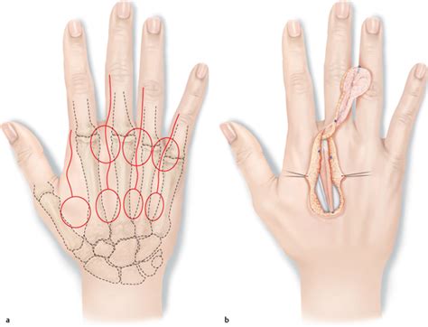 Dorsal Metacarpal Artery Flaps and Dorsal Metacarpal Flaps ...