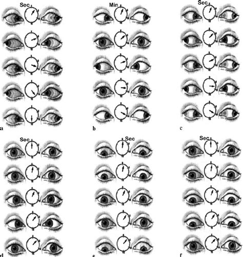 Common eye movement abnormalities. Spontaneous eye movements rarely ...