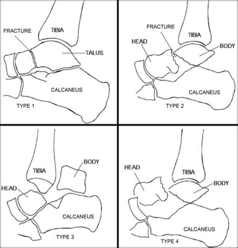 Hawkin’s Classification for Talus Fractures : Mnemonic | Epomedicine