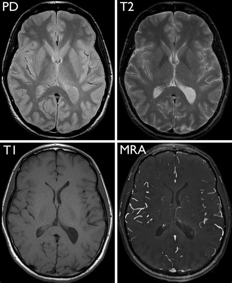 38+ Anatomy Brain On Mri Background