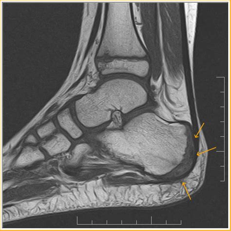 Calcaneal Apophysitis: Sever's Disease - Sumer's Radiology Blog