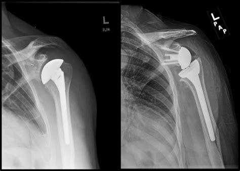 Reverse Shoulder Replacement - The Shoulder and Elbow Center