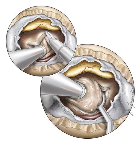 Craniopharyngioma | The Neurosurgical Atlas, by Aaron Cohen-Gadol, M.D.