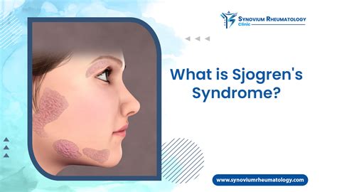 What is Sjogren’s Syndrome? - Symptoms & Causes | Synovium