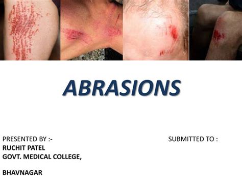 Abrasions | PPT