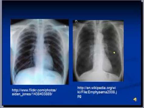 Emphysema Chest X Ray