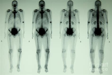 Nuclear Bone Scan Photograph by Inga Spence - Pixels