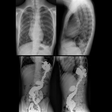 Congenital Diaphragmatic Hernia | Pediatric Radiology Reference Article ...