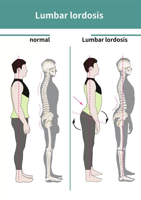 Lumbar Lordosis: Definition, Causes, Symptoms, Diagnosis, and Treatment ...