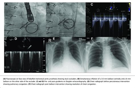 Balloon Valvuloplasty of Bileaflet Prosthetic Aortic Valve | Download ...