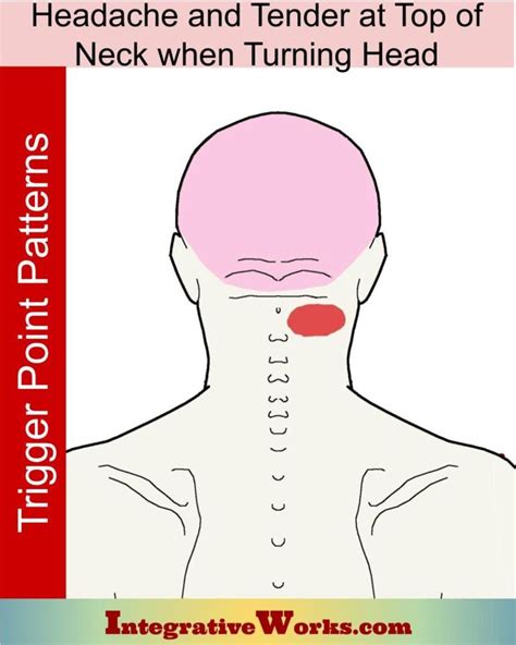 Forward Head Posture: Pain Patterns, Causes, Self-Care – Integrative ...