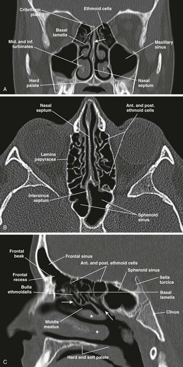 Ethmoid Sinus Anatomy In A Year Old Girl Sagittal Ct Image In Bone ...