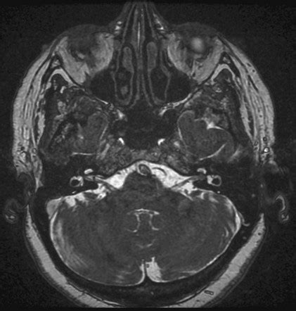 Vestibular schwannoma | Radiology Reference Article | Radiopaedia.org