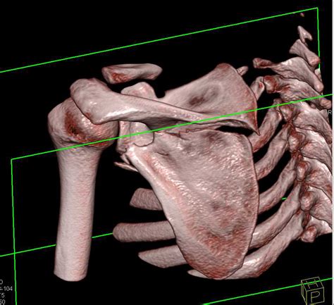 Scapular Fracture X Ray