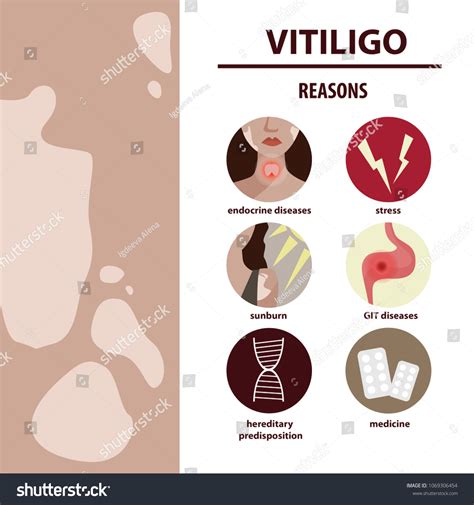 Infographics Vitiligo Causes Disease Stock Vector (Royalty Free ...