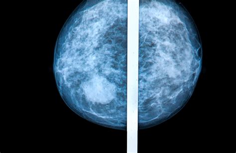 What are False-Positive & False-Negative Mammograms? | Two Views