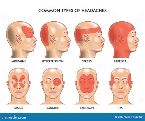 Headache Types Vector Illustration | CartoonDealer.com #275850386