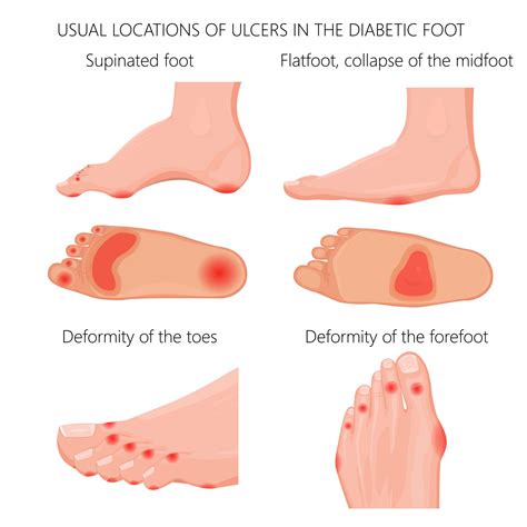 Arterial Ulcer On Toe