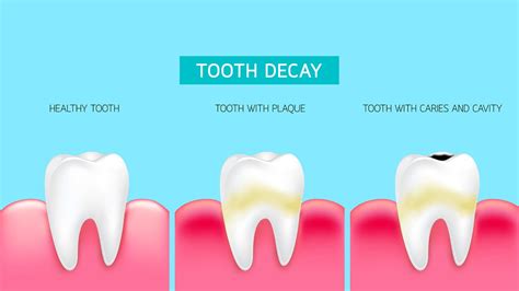 Tooth Decay Process In Adults & Young Children | Dentist Harrisburg NC