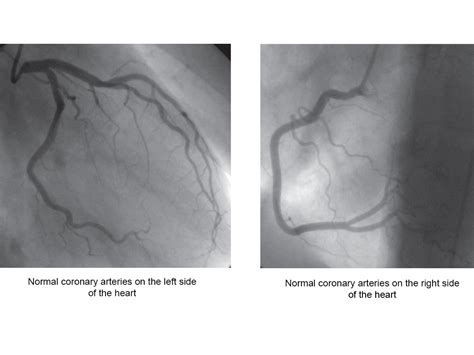 Coronary Angiography- Heart Test, Recovery & Risk - Heart Foundation NZ