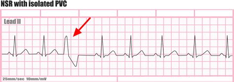 Ectopic beats causes, symptoms, diagnosis, treatment & prognosis