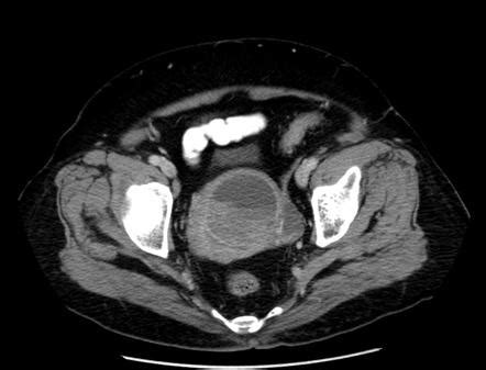 Uterine leiomyosarcoma | Image | Radiopaedia.org