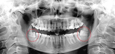 Wisdom Teeth Extraction - Tooth Removal Springvale & Carrum Downs