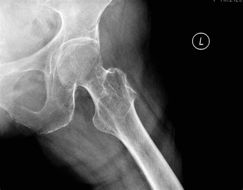 FEMUR ANATOMY - lateral xray Diagram | Quizlet