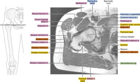 MRI of the hip | Radiology Key