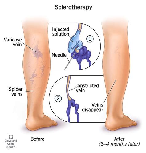 Sclerotherapy: Treatment for Varicose and Spider Veins