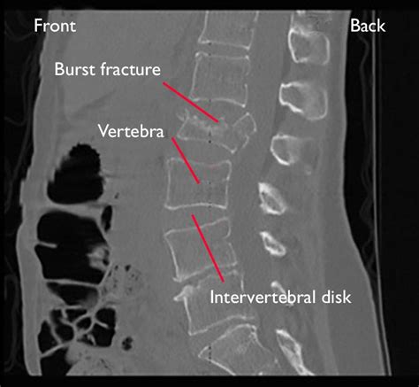 Fractures of the Thoracic and Lumbar Spine - OrthoInfo - AAOS