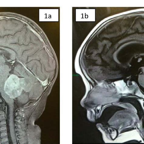 A) MRI image, T1 sequence with contrast of the patient before surgery A ...