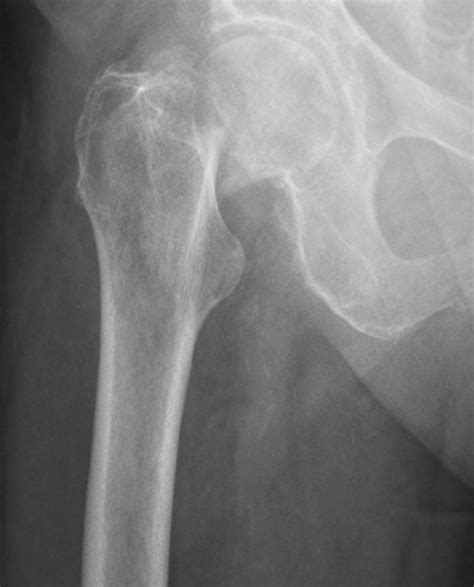 Hip Fracture – Femoral Neck Fracture – Undergraduate Diagnostic Imaging ...