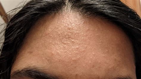 [Skin Concerns] Any idea what these forehead bumps are? : r ...